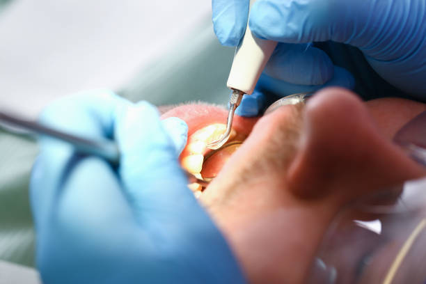 Best Emergency Root Canal Treatment in Wentzville, MO